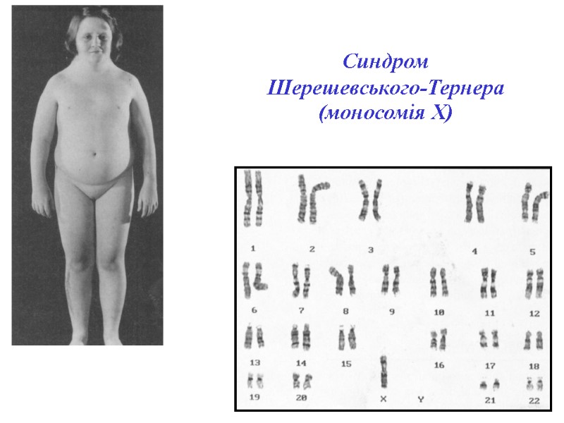 Синдром  Шерешевського-Тернера (моносомія Х)‏